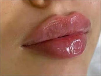 lips-filler-picture-8