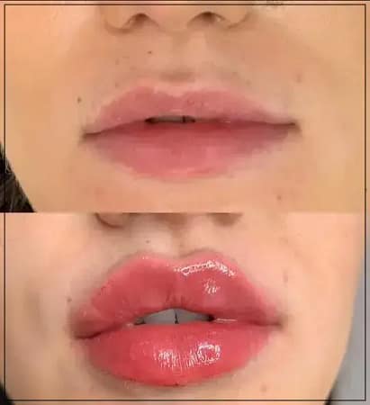 lip-filler-picture-1